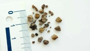 МКБ за границей