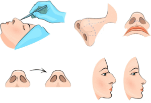 Пластическая операция на нос в Корее Ринопластика носа