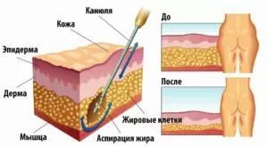 Липосакция бёдер в Корее
